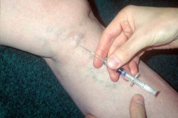 escleroterapia para venas varicosas