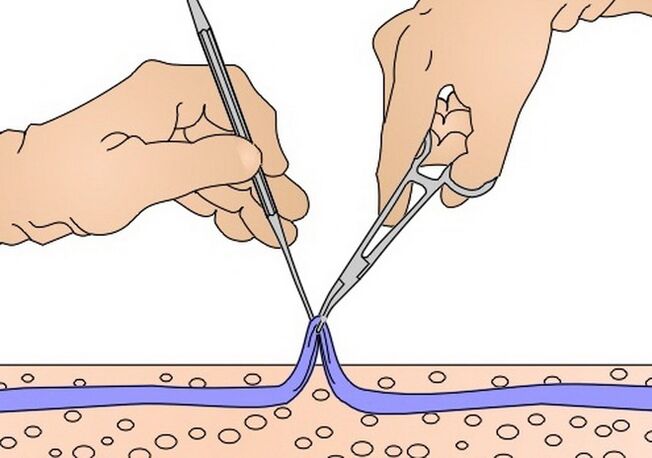 Extracción de venas para venas varicosas