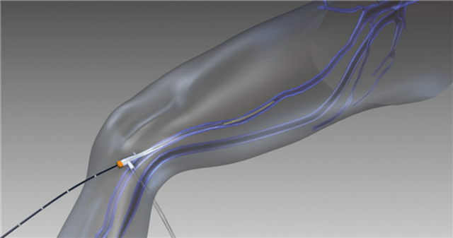 obliteración por radiofrecuencia para venas varicosas