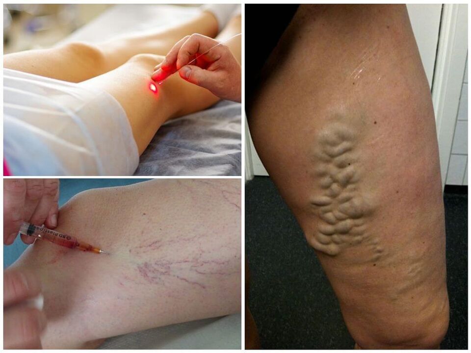 Métodos de tratamiento no quirúrgico de las venas varicosas de las piernas.