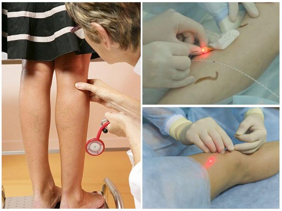 Progreso del procedimiento de coagulación con láser para las varices de las piernas.