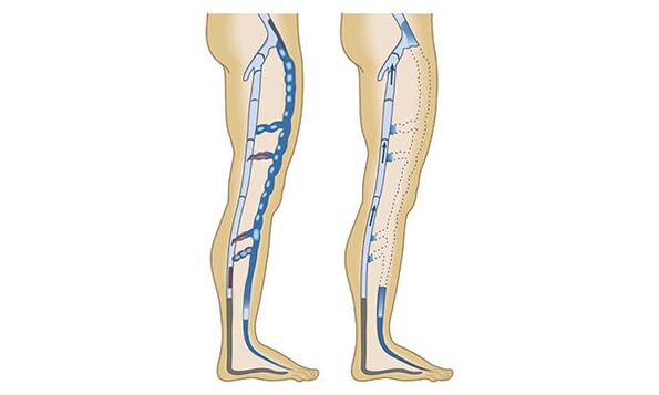 venas sanas y enfermas en las piernas