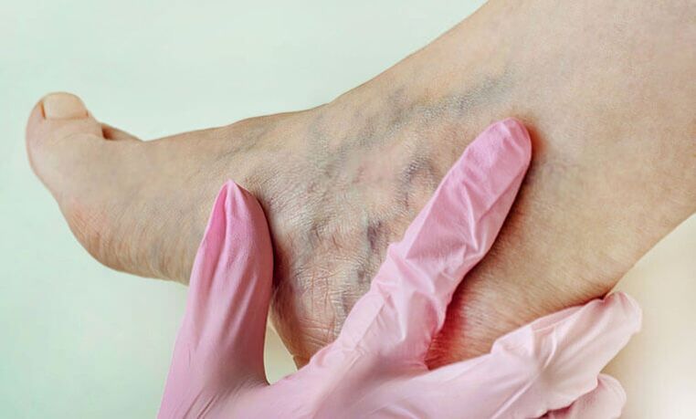venas varicosas en las piernas
